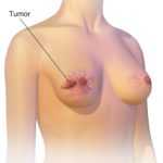 Jak poznat rakovinu prsu - Projevy, příznaky, kontrola