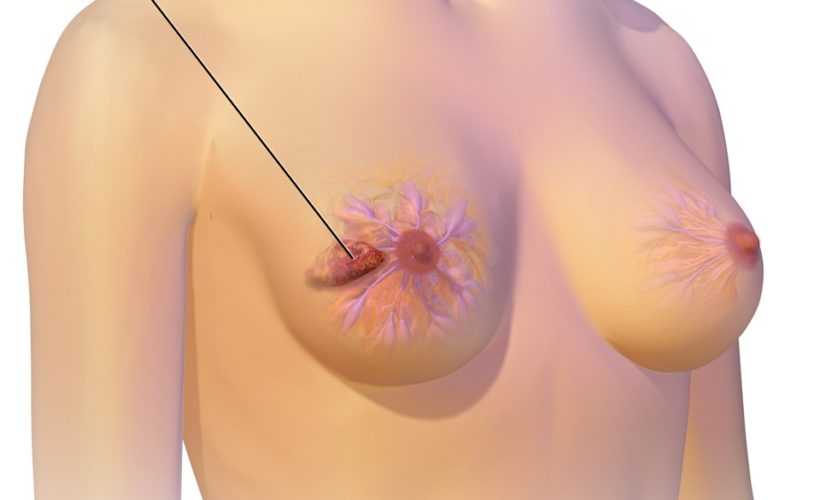Breast Cancer